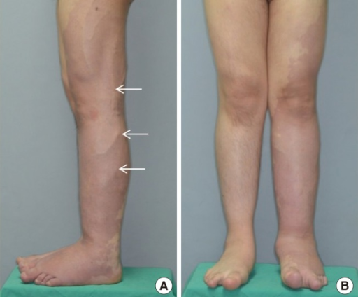 Klippel-Trenaunay syndrome: case 1Geographic stain on t | Open-i