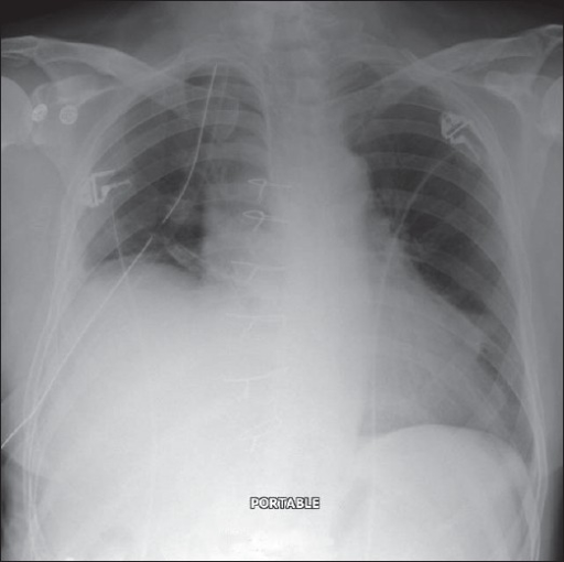 A subpulmonic effusion mimicking an elevated right hemi | Open-i