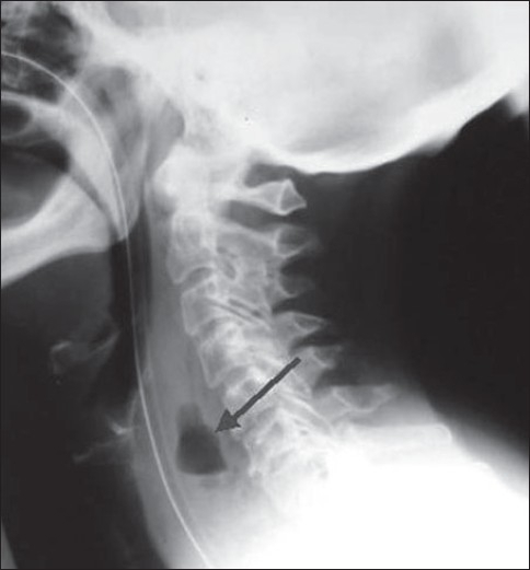 A lateral radiograph of the neck showing a collection o | Open-i