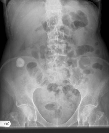 X Ray Of The Abdomen Showing Calcification In Right Ili 