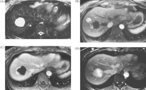 Benign Liver Lesions In A Patient With Colorectal Cancer A Tse T2 Image Benign Liver Lesions In A Patient With Colorectal Cancer A Tse T2 Image