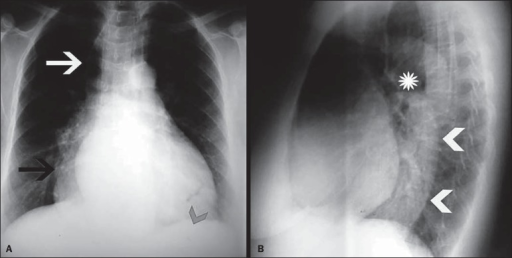 Grade III megaesophagus. A: Posteroanterior X-ray showingright inferior mediastinal widening (black arrow) and right superiormediastinal widening, the latter simulating a pneumomediastinum due togas content inside of the esophagus (white arrow). Absence of thegastric air bubble (arrowhead). B: Lateral X-ray showing anair-fluid level (asterisk) and a retrocardiac mass (arrowheads).
