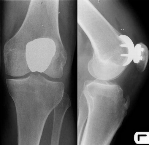 Radiograph of left knee showing dissociation of the pol | Open-i