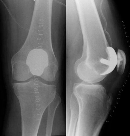 Radiograph of left knee after conversion to the Richard | Open-i