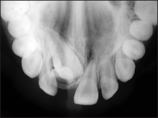 Preoperative maxillary occlusal radiograph revealing im ...