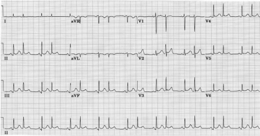 Aberrant ventricular conduction following premature atr | Open-i