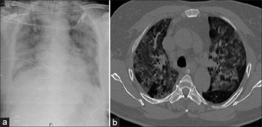 Chest X-ray PA View (a) Showing Bilateral Fluffy Opacit | Open-i