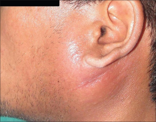Parotid swelling on left side | Open-i