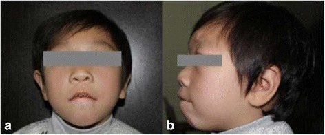 Abnormalities Of The Craniofacial Appearance Facial Ap Open I