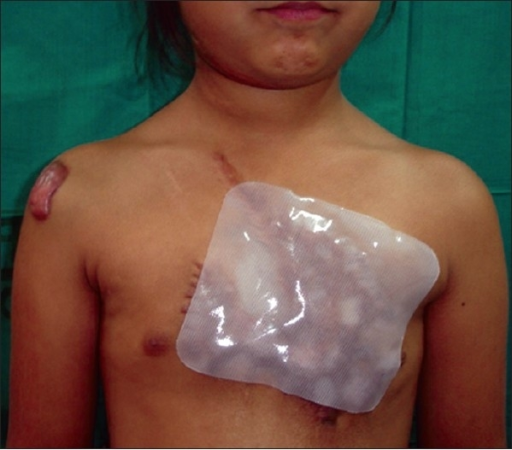 post burn hypertrophic scar being treated with silicone open i hypertrophic scar silicone sheet
