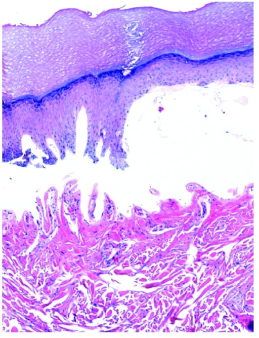 Porphyria cutanea tarda: subepidermal bulla and festoon | Open-i