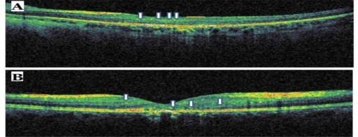 Sample Optical Coherence Tomography Scans From Patients With Commotio Retina A And Central Retinal Sample Optical Coherence Tomography Scans From Patients With Commotio Retina A And Central Retinal