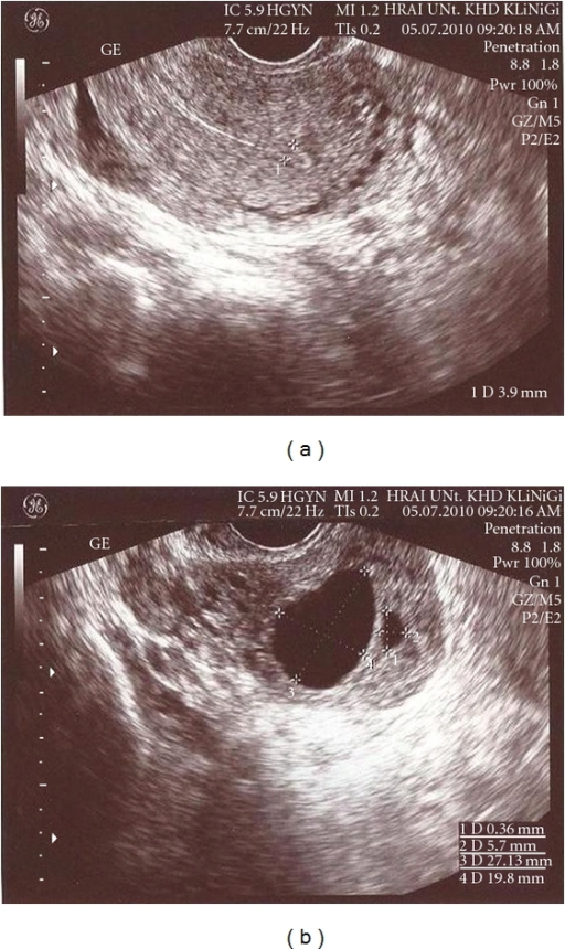 Gynaecological needles - Vitrolife