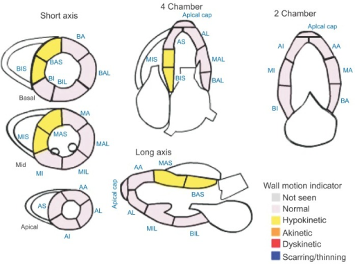 Wall motion diagram of first transthoracic echocardiogram. AA, apical ...