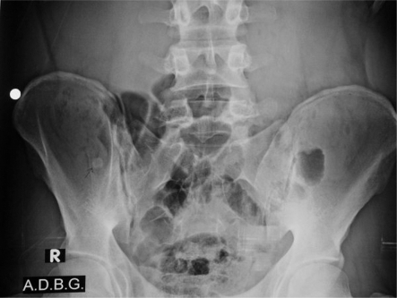 An opacity (appendicolith) in abdominal x-ray. | Open-i