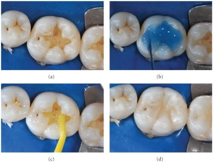 La Incrustacion Dental Los Tipos De Incrustaciones Y Materiales