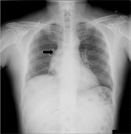 chest-x-ray-anatomy-hilar-structures