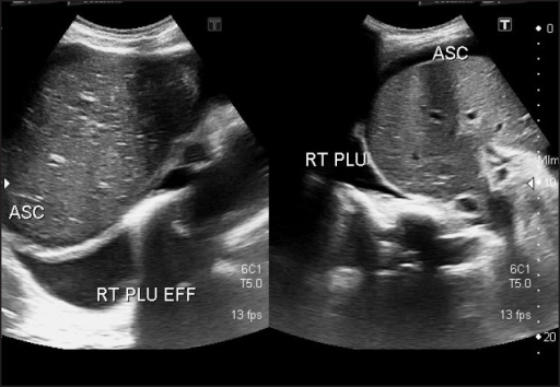 Image Showing Pleural Effusion And Ascites Right Side Open I