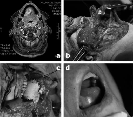 genioglossus mri