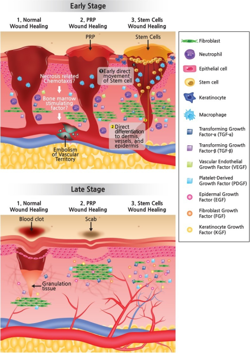 As compared with normal wound healing or PRP wound heal | Open-i