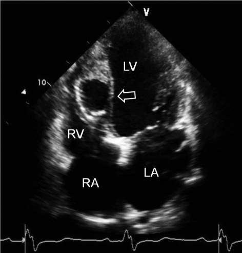 Transthoracic echocardiography in the apical 4-chamber | Open-i