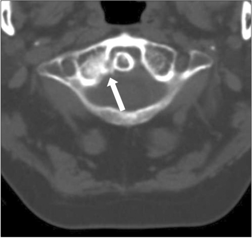 Axial View On Cervical Ct Scan Shows An Old Fracture Of Open I