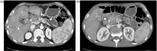 Mass-forming chronic pancreatitis. (a, b) Axial CT imag | Open-i