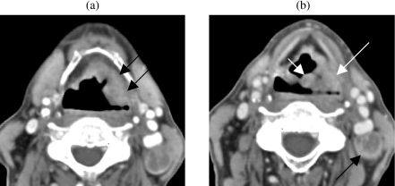 (a) Axial post-contrast CT image shows an exophytic a l | Open-i