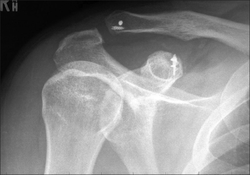 Radiograph of the shoulder 6 months after surgical stab | Open-i