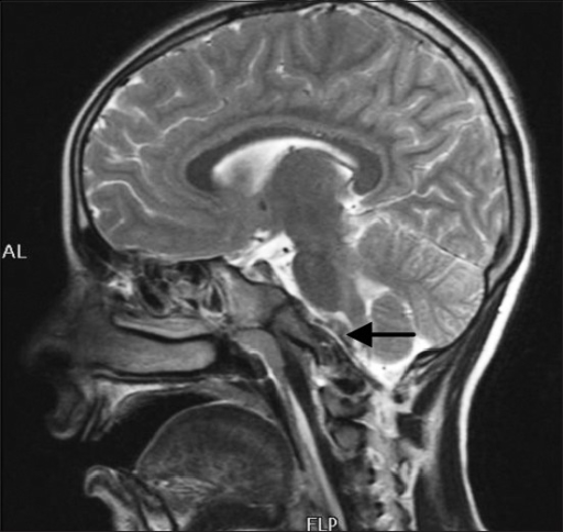Sagittal T2 W Mri Brain Showing Hypodense Edh Hematoma Open I