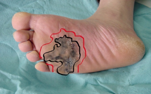 Wide Excision Of Malignant Melanoma Of The Plantar Area Open I 4519