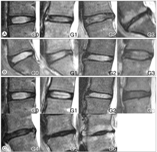 References of image for disc degeneration are shown. Th Openi