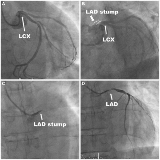 Coronary angiography and primary percutaneus coronary i Openi