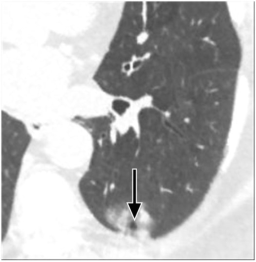 A low-dose chest CT scan shows a part-solid nodule with | Open-i