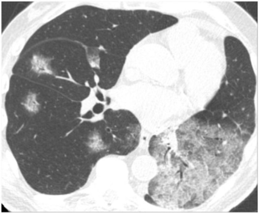 Ct Through The Lower Lungs Demonstrates Bilateral Groun Open I