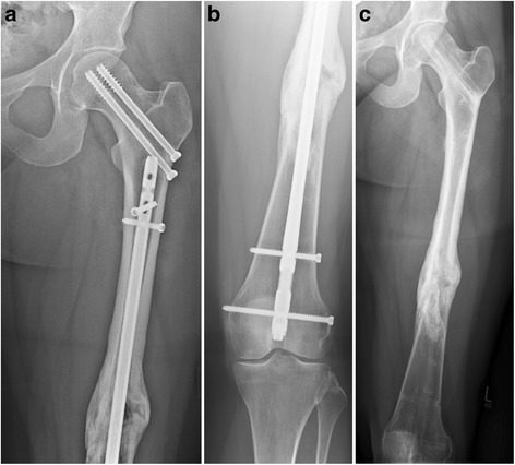 Post-Traumatic Knee Replacement Without Removing Hardware