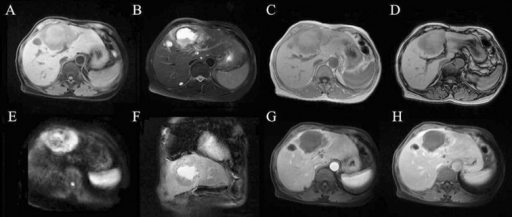 The different sequences of MRI showing the hepatic absc | Open-i