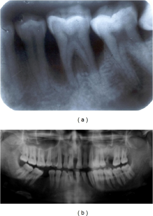 (a) Arc-shaped radiolucency at the 1st molar region in | Open-i