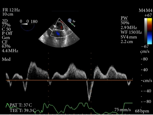 Pulse wave Doppler interrogation of the left superior p | Open-i