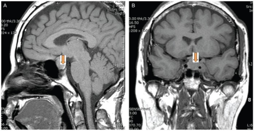 Pituitary magnetic resonance imaging at pregnancy 34 we | Open-i