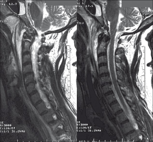 MRI of the spinal cord contusion and epidural hematoma | Open-i