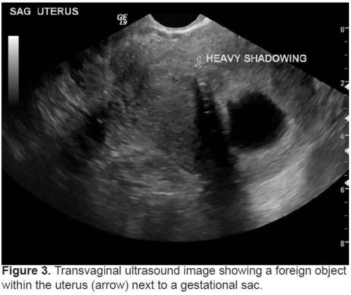 Transvaginal ultrasound image showing a foreign object | Open-i