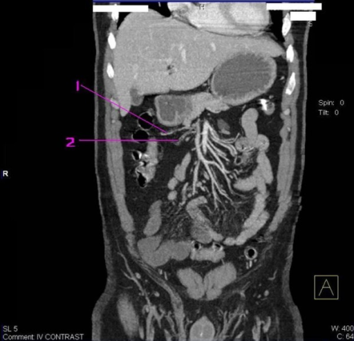 Abdominal Angio Ct Coronal Reconstructed Image Revealed 