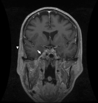 MRI coronal view shows perineural enhancement of the ri | Open-i