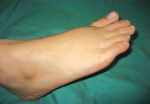 Swelling Over Dorsum Of Right Foot Open I