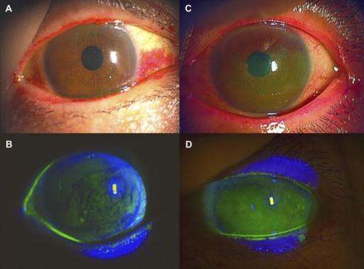 Dry Eye Slit Lamp