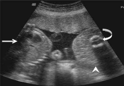 Case 2: Transabdominal USG shows a monochorionic, monoa | Open-i