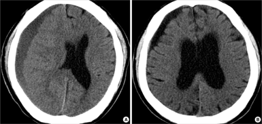 CT scan 30 days after admission demonstrates chronic SD | Open-i