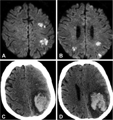 Brain magnetic resonance imaging on day 3 of hospitaliz | Open-i