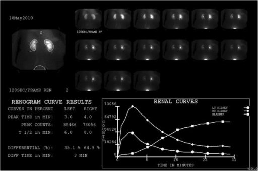 Renal Scan Procedure